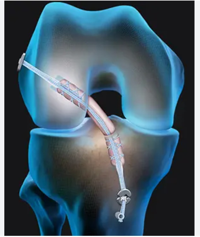 Cirugía de Reconstrucción de Ligamento Cruzado Anterior en Interlomas - Ortopedia GAVE