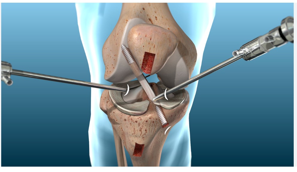 Cirugía de Reconstrucción de Ligamento Cruzado Anterior en Interlomas - Ortopedia GAVE