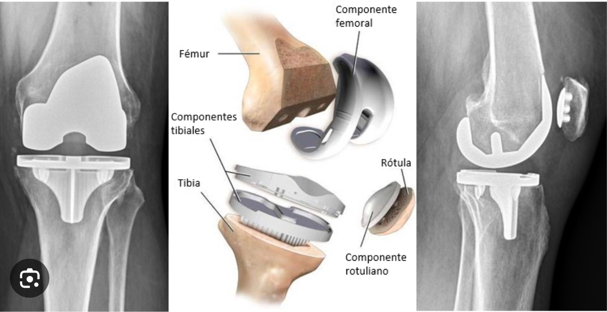 Cirugía de Reemplazo de Rodilla en Interlomas - Ortopedia GAVE